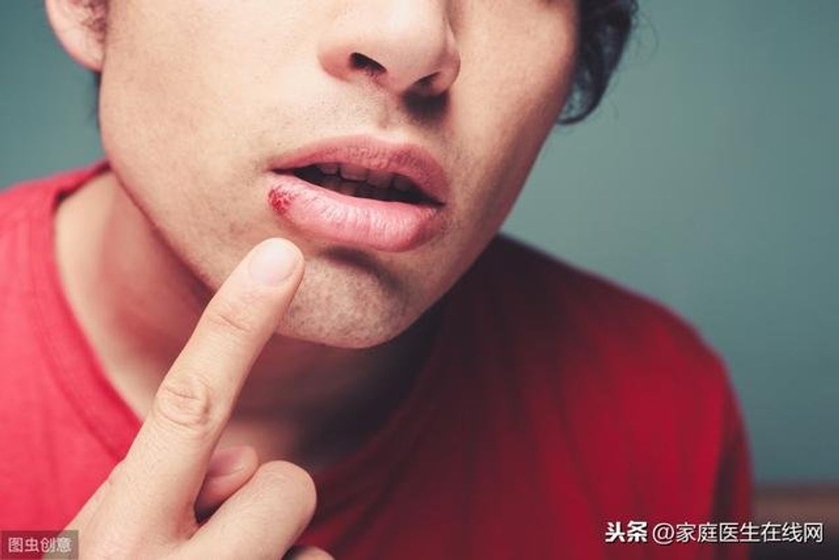 嘴破發燒… 小兒患疱疹性齒齦炎增加 | 中華日報|中華新聞雲