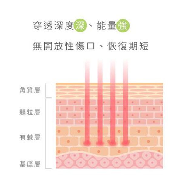 【3D飛梭雷射】撫平凹疤、痘疤